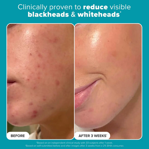 Paula's Choice - EXFOLIATE 2% BHA Liquid Exfoliant 236ml Fantastic Look Albania Tirana