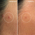 The INKEY List - Hydrocolloid Invisible Pimple Patches    Fantastic Look Albania Tirana