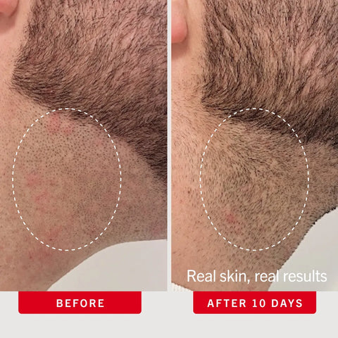First Aid Beauty - Ingrown Hair Pads with BHA + AHA 60 Pads