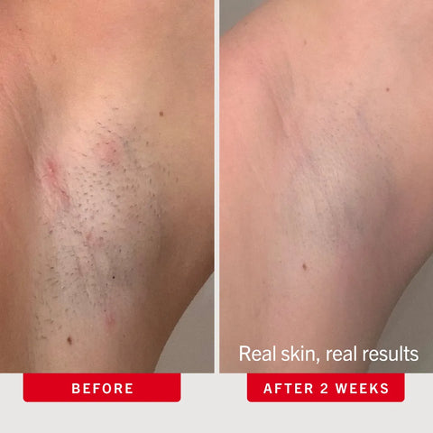 First Aid Beauty - Ingrown Hair Pads with BHA + AHA 60 Pads